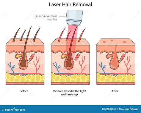 Laser Hair Removal Process Diagram Medical Stock Illustration ...