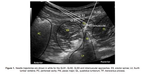 Quadratus Lumborum Block Anatomy Porn Sex Picture