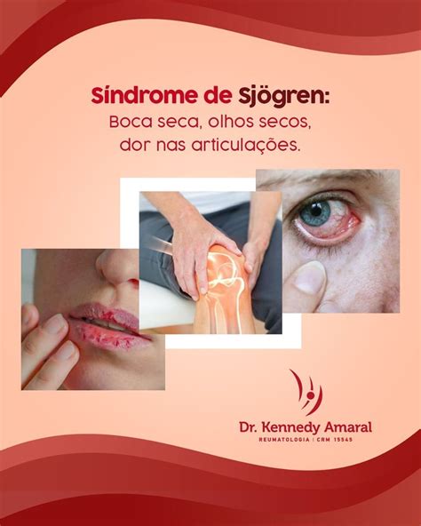 Síndrome De Sjogren Boca Seca Olhos Secos E Dor Nas Articulações