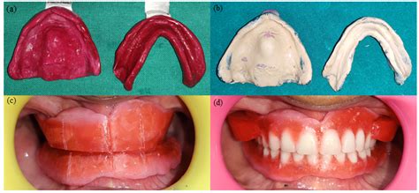 A Primary Impression B Secondary Impression C Maxillomandibular