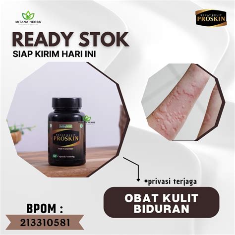 Jual Mitana Herbal - Obat Biduran Anak Dan Dewasa - Obat Biduran Alergi Dingin - Obat Biduran ...