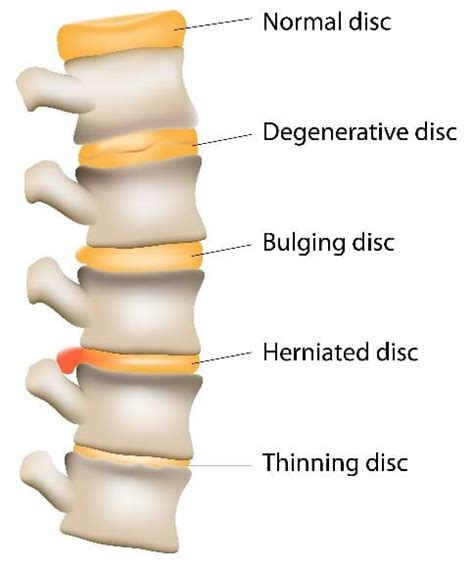 Bulging Disc Relief | Gentle and Safe | Chiropractor HQ