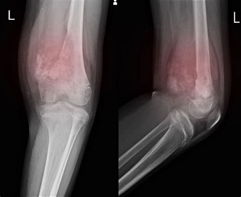 soft tissue sarcoma  symptoms  treatment hyperthermia