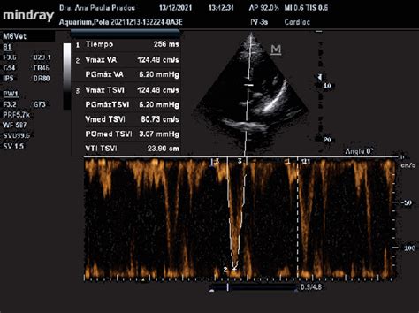 Doppler Tracing Of Velocity Time Integral Obtained In Left Ventricular Download Scientific