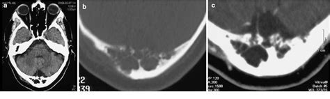 Figure 1 from Hypertrophic Arachnoid Granulation of the Occipital Bone Neuroradiological ...