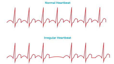 Heart Rhythm Disorders - Dr. KS Kishore