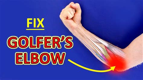 How To Fix Golfers Elbow The 3 BEST Medial Epicondylitis Exercises