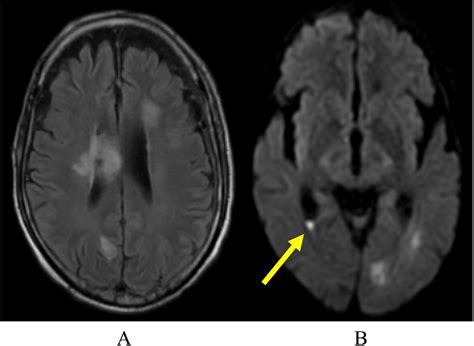 Intraventricular Rupture Of Aspergillus Brain Abscess During Remission Induction International