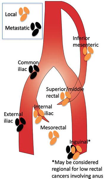 MRI Rectal Cancer Staging - RAD-ASSIST