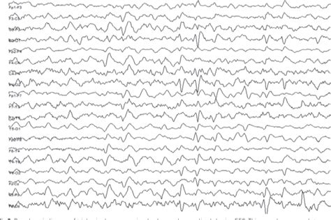 Figure 3 From Periodic Eeg Patterns Importance Of Their Recognition