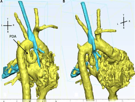 The 3d Reconstruction Shows From The Back Of The Patient Aortic Download Scientific Diagram