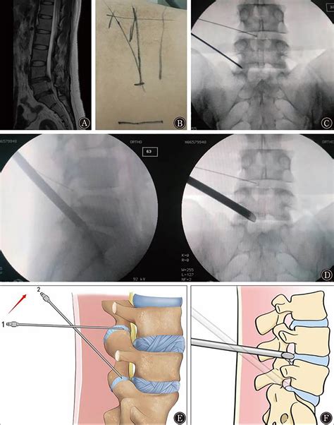 Onestage Percutaneous Endoscopic Lumbar Discectomy For Symptomatic