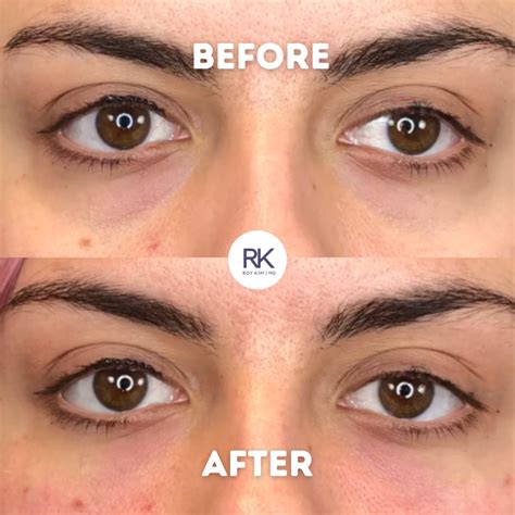 Revive Your Eyes The Nonsurgical Solution To Under Eye Bags Roy Kim Md