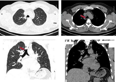 Axial And Coronal Non Contrast Enhanced Image Of Computed Tomography