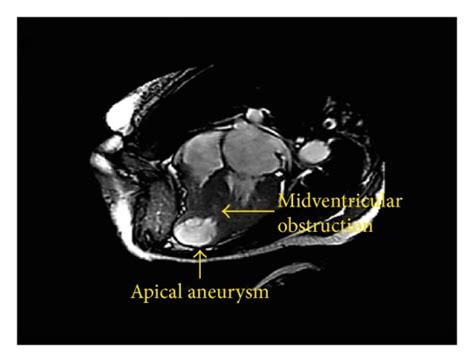 A Cine 4 Chamber Image Of Cardiac MRI Done With Steady State Free