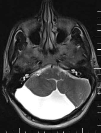 Posterior Fossa Arachnoid Cyst MRI