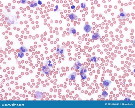 Chronic Eosinophilic Leukemia. Stock Photo - Image of marrow, leukemia ...