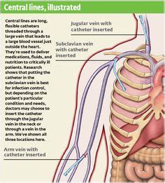 19 Central line care ideas | central line, infection prevention, nursing education