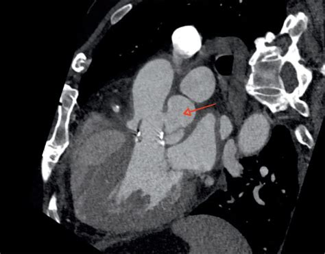 A Case Of Infected Mitral Aortic Intervalvular Fibrosa Pseudoaneurysm