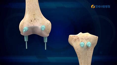 서울연세사랑병원 3d맞춤형 인공관절수술 기술력을 확인하세요 네이버 Tv