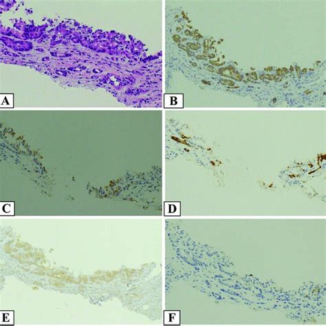 Figure6 The Pathological Findings Of The Tumor Of Posterior Superior