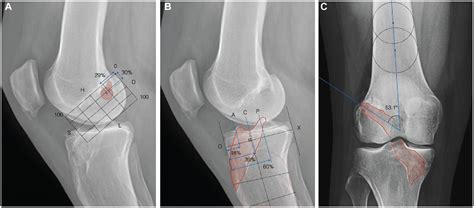 Tunnel Management In Revision Anterior Cruciate Ligament Reconstruction