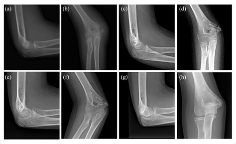 A And B Displaced Fracture Of The Medial Epicondyle Of A Right