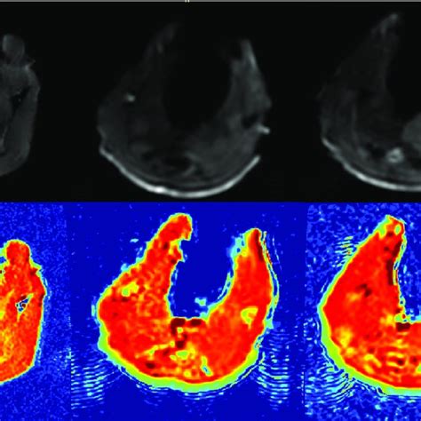 Representative DWI And ADC Maps Of Ischemic Muscles After Left Iliac