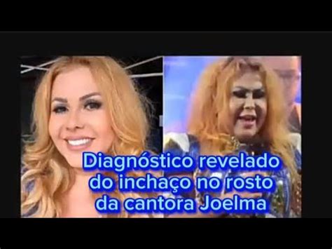 O Que Aconteceu A Cantora Joelma J Saiu O Diagn Stico M Dico Youtube