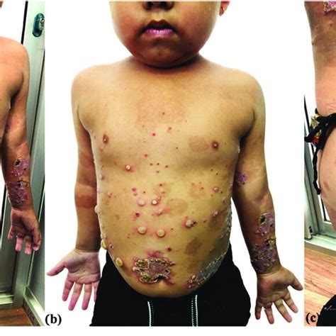 Mul Ple Tense Vesicles And Bullae With Erosions And Crusts Over The Download Scientific