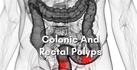 Colonic & Rectal Polyps Removal Singapore - Dr Aaron Poh