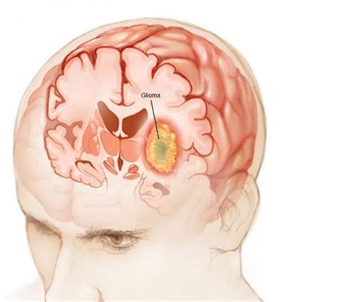 脑胶质瘤【多图】39医疗图集 39健康网