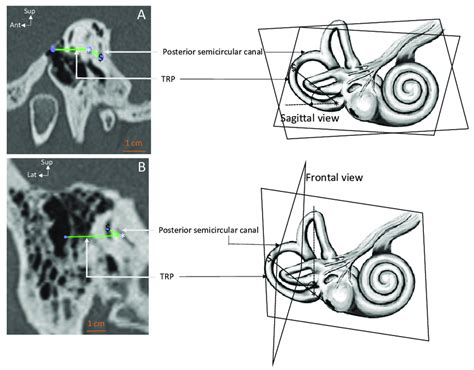 Angle Measurements For The Posterior Semicircular Canal Scc In The Download Scientific