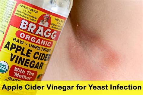 How To Use Apple Cider Vinegar For Vaginal Yeast Infection