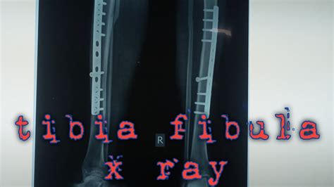 Tibia Fibula X Ray Positioning Tibia Fibula Physiotherapy Tibia Fibula