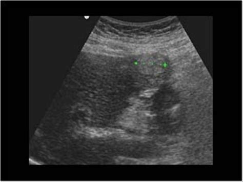 Abdomen and retroperitoneum | 1.1 Liver : Case 1.1.7 Hepatocellular ...