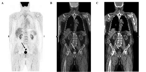 Pet Scan Colon Cancer