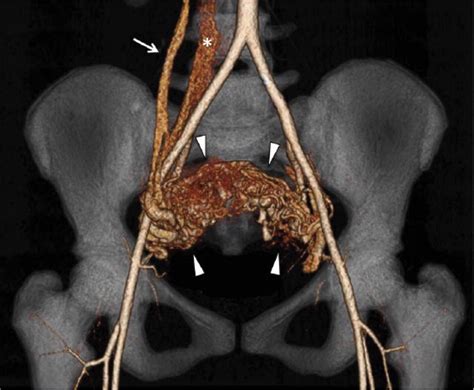 Uterine Arteriovenous Malformation Umberto G Rossi Pierluca Torcia