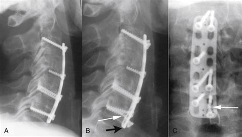 Subsidence And Dynamic Cervical Spine Stabilization Neupsy Key