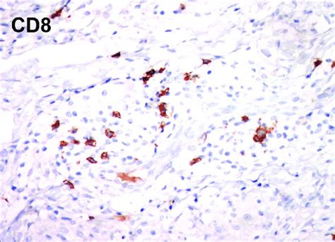 D Immunohistochemistry Showing Reduced Staining For Cd8 ×100