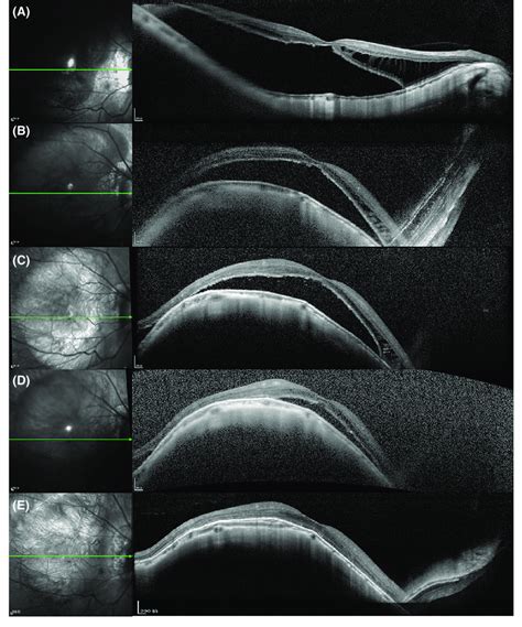 Preoperative And Postoperative Oct Scans Of A Patient With Fs And Md