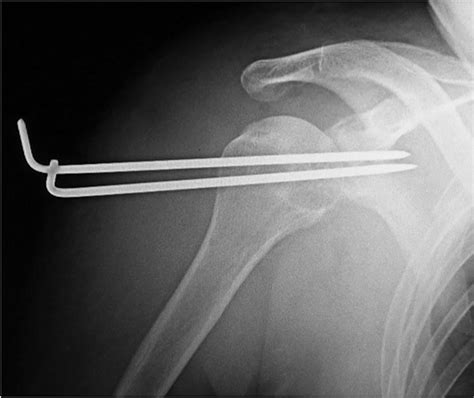 Migration Of A Kirschner Wire Into The Lung With Shoulder Dislocation