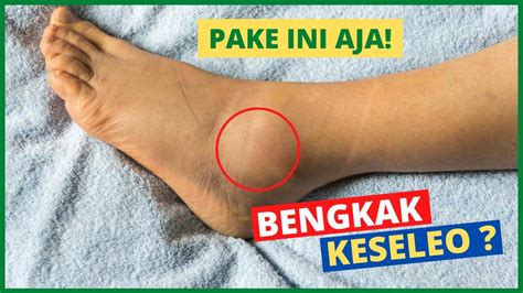 Cara Mengobati Bengkak Karena Keseleo Cara Merawat Kaki Bengkak YouTube