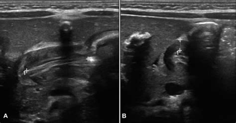 Hypertrophic Pyloric Stenosis The Operative Review Of Surgery