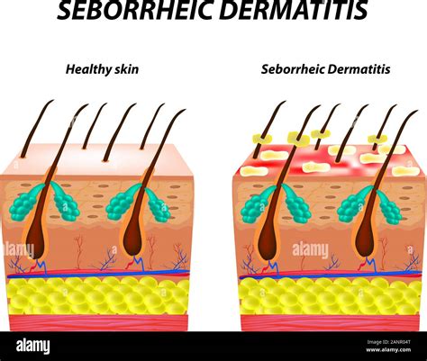 Dandruff Vs Seborrheic Dermatitis