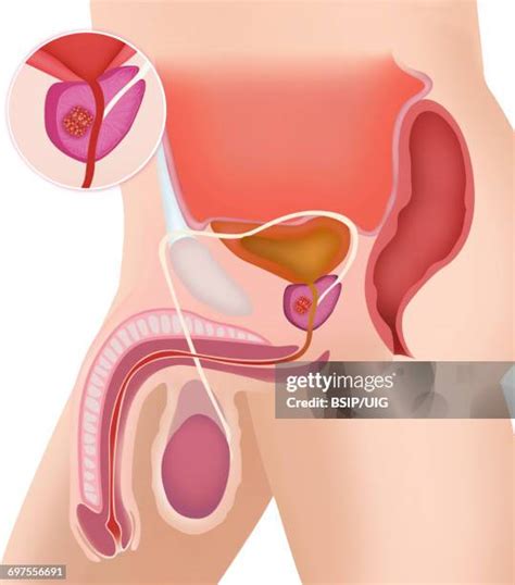 Prostate Cancer Anatomy Photos And Premium High Res Pictures Getty Images