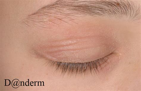 atopic dermatitis eyelid - pictures, photos