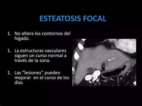 LESIONES FOCALES HEPATICAS EN ULTRASONIDO PPT