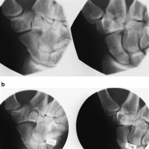 a MRI of the left wrist a few hours after a fall demonstrating a... | Download Scientific Diagram