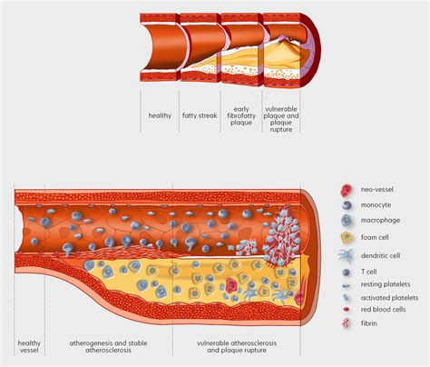 Atherosclerosis Stages